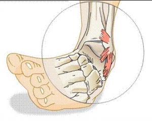 Ankle_Sprain