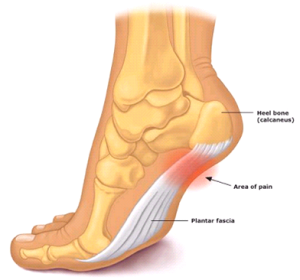 Heel Pain Treatment