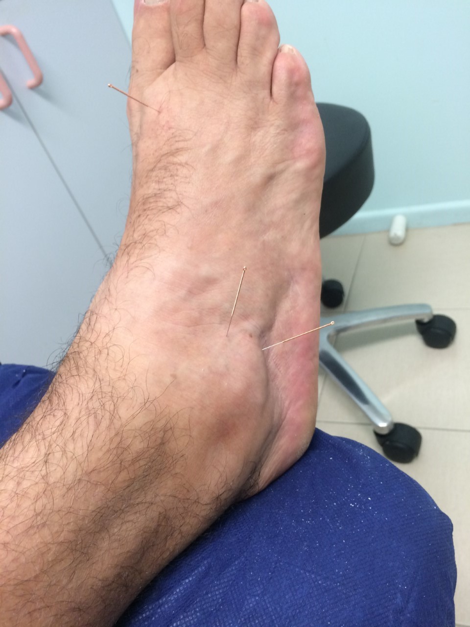 DRY NEEDLING First in Feet